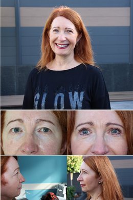 Bilder einer Patientin in den mittleren Jahren vor und nach ihrer Schlupflider-Behandlung bei den Augenpartnern Walsrode 