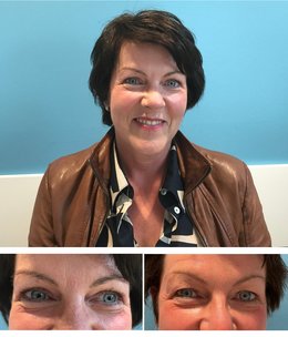 Frau Mitte 50 hat ihre Schlupflider bei den Augenpartnern behandeln lassen, das Bild zeigt Bilder vor und nach der Operation