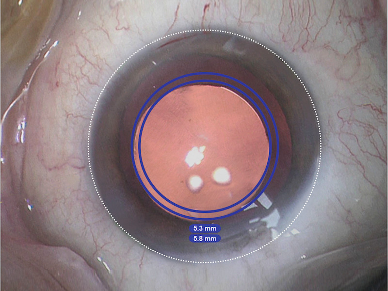 CALLISTO® eye - Einblendung der genauen Form und Größe der Kapsulorhexis 