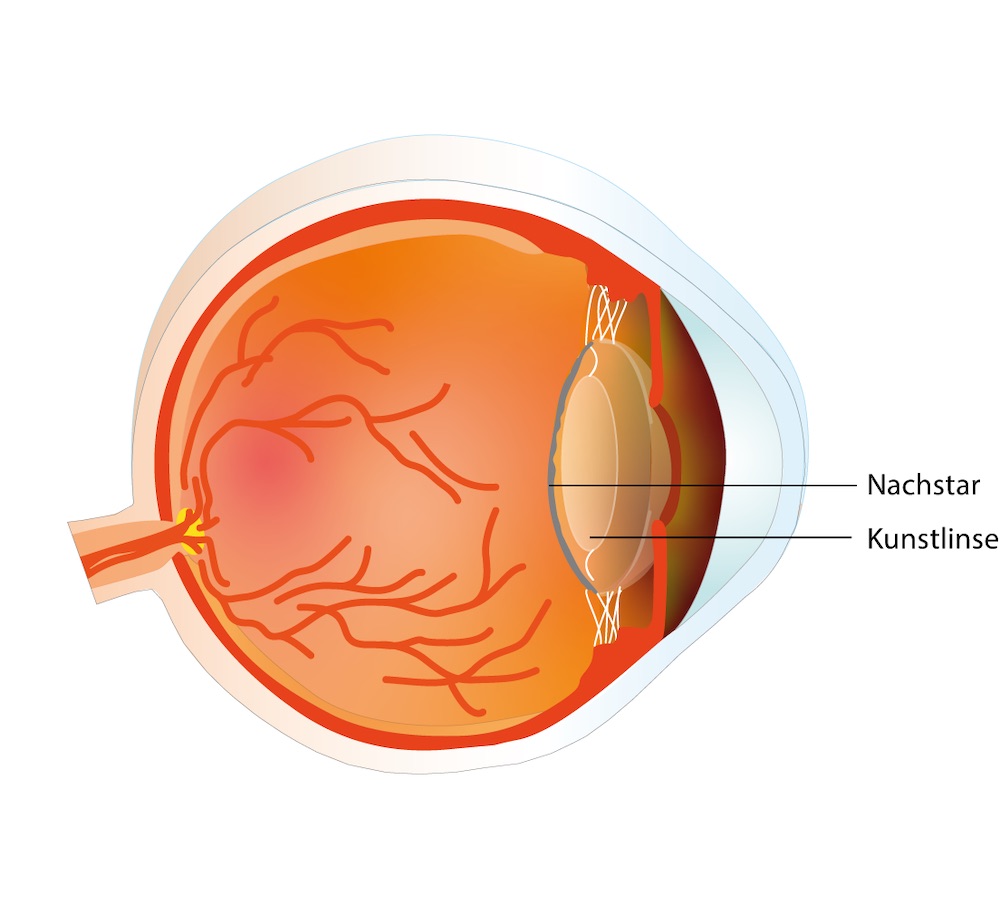 Das Bild zeigt den Nachstar, eine eingetrübte Linsenkapsel im Auge nach der Grauer Star Operation