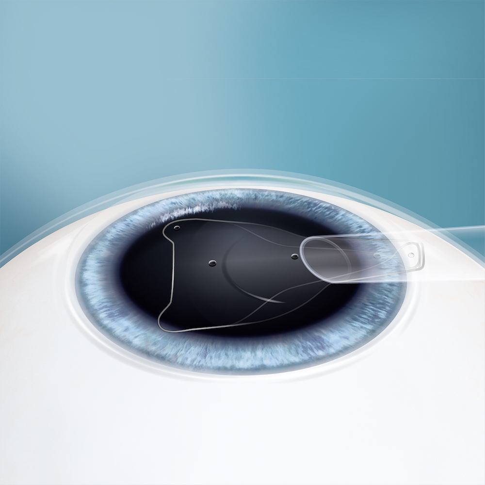 Bild zeigt das Auge beim zweiten Schritt zur Brillenfreiheit mit EVO Visian ICL